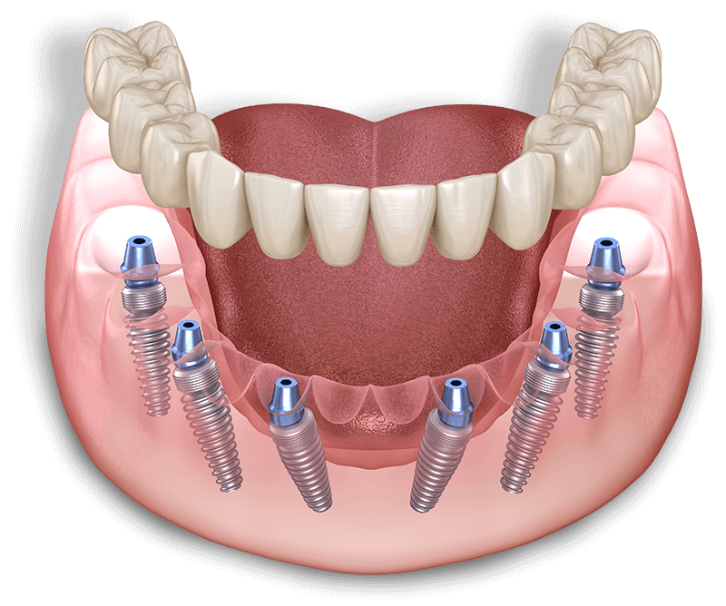 full arch dental illustration assets