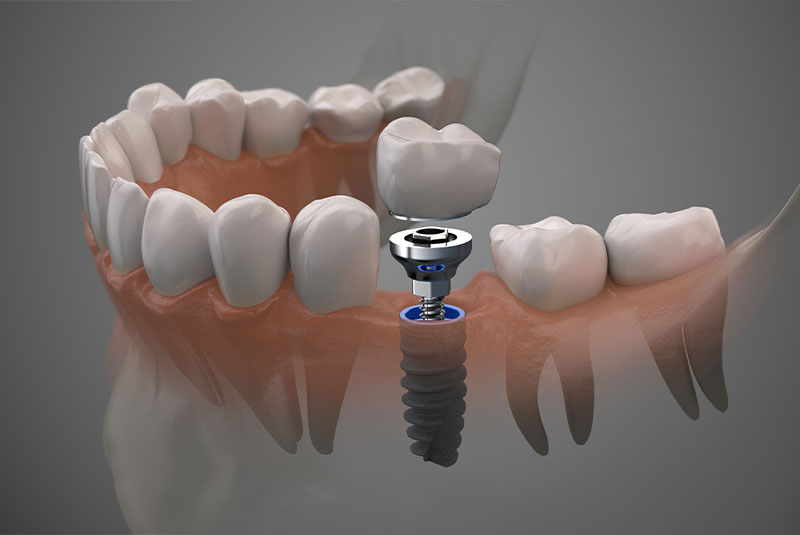 Dental Implants