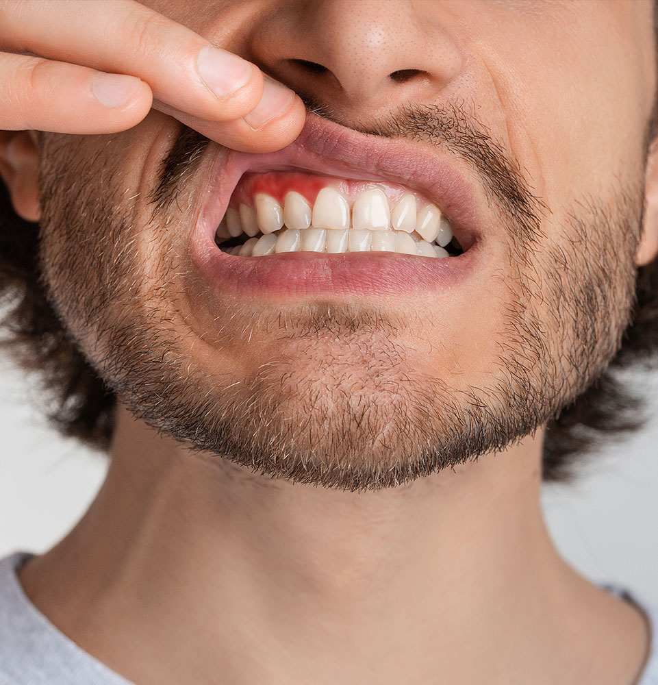 Gum Disease