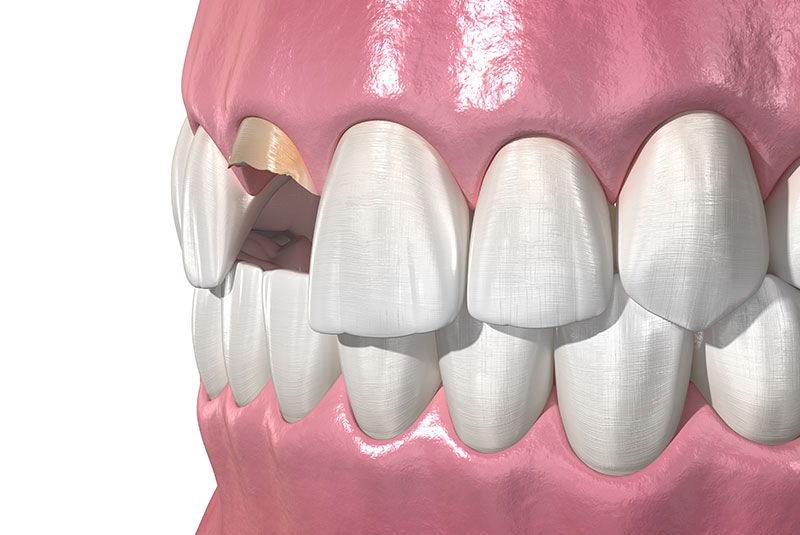 Broken tooth