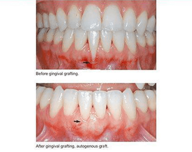 Before and after procedure image