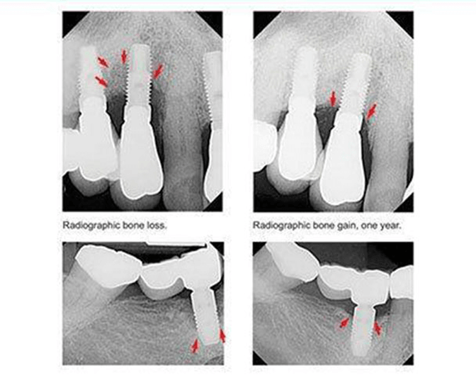 Before and after procedure image
