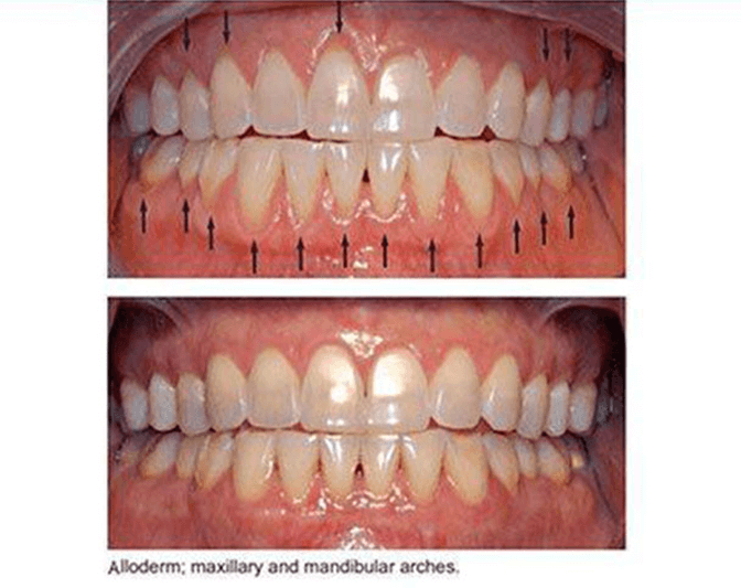 Before and after procedure image