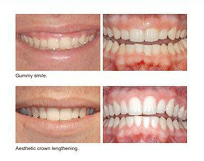 Before and after procedure image