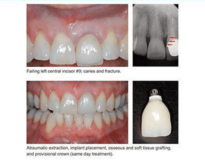 before and after procedure image