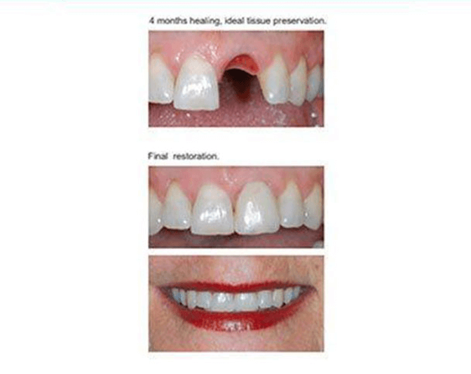 Before and after procedure image