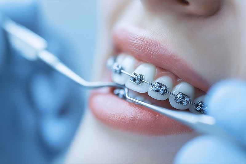 Close-up of dental checkup with orthodontic braces, professional oral care and teeth alignment procedure