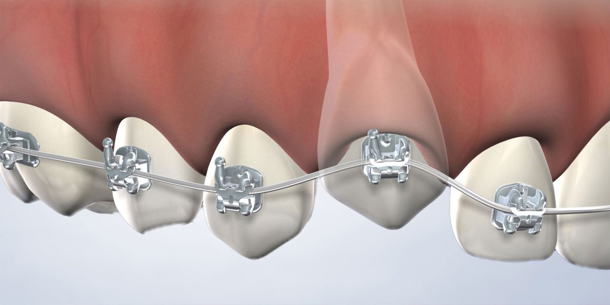 illustration of exposed canine